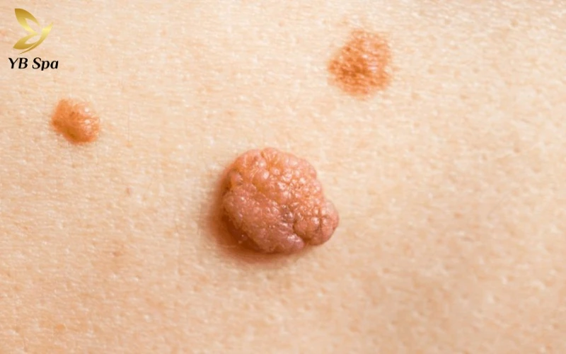 Hình ảnh nổi mụn ở vùng kín nữ - Khi nào cần đến gặp bác sĩ? 12 Tổng hợp hình ảnh nổi mụn ở vùng kín nữ giúp bạn chủ động phân biệt giữa kích ứng thông thường và các bệnh lý lây truyền qua đường tình dục