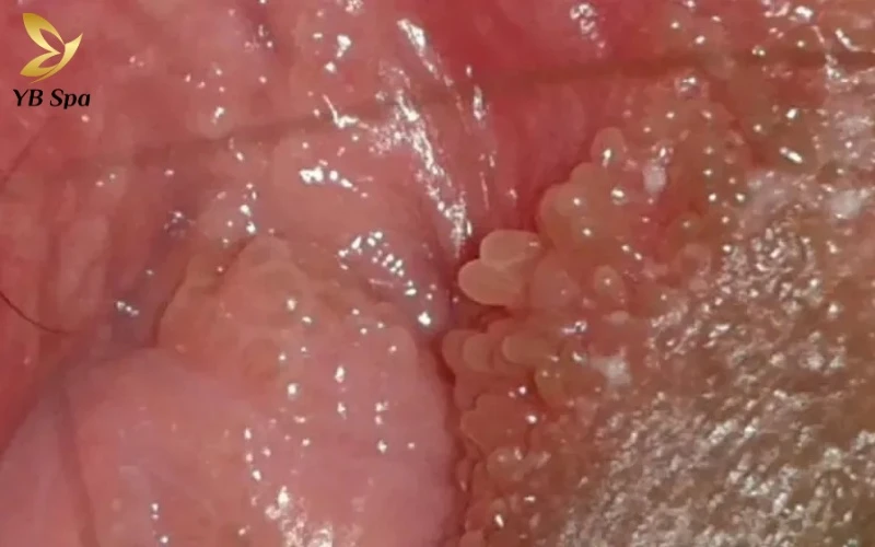 Hình ảnh nổi mụn ở vùng kín nữ - Khi nào cần đến gặp bác sĩ? 21 Gai sinh dục biểu hiện qua các nốt mụn thịt nhỏ màu trắng hoặc hồng, mọc thành hàng đều đặn quanh môi lớn và môi bé.