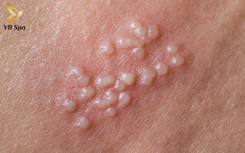 Hình ảnh nổi mụn ở vùng kín nữ - Khi nào cần đến gặp bác sĩ? 13 Mụn mủ trắng hoặc vàng là dấu hiệu cảnh báo tình trạng nhiễm khuẩn hoặc viêm nang lông tại vùng kín