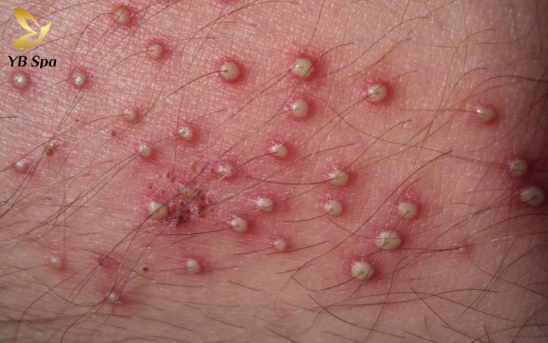 Hình ảnh nổi mụn ở vùng kín nữ - Khi nào cần đến gặp bác sĩ? 14 Viêm nang lông vùng kín thường biểu hiện qua các nốt sẩn đỏ hoặc mụn mủ khu trú ngay tại vị trí các lỗ chân lông