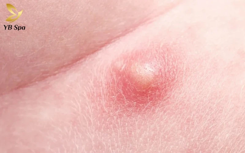 Hình ảnh nổi mụn ở vùng kín nữ - Khi nào cần đến gặp bác sĩ? 15 Các hóa chất trong nước giặt hoặc dung dịch vệ sinh có độ pH không phù hợp là tác nhân phổ biến gây kích ứng da nhạy cảm