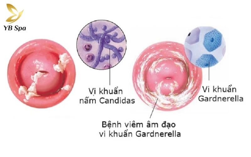 Hình ảnh nổi mụn ở vùng kín nữ - Khi nào cần đến gặp bác sĩ? 17 Sự tiếp xúc liên tục với dịch tiết nhiễm nấm Candida hoặc vi khuẩn là nguyên nhân chính dẫn đến viêm da tiếp xúc thứ phát