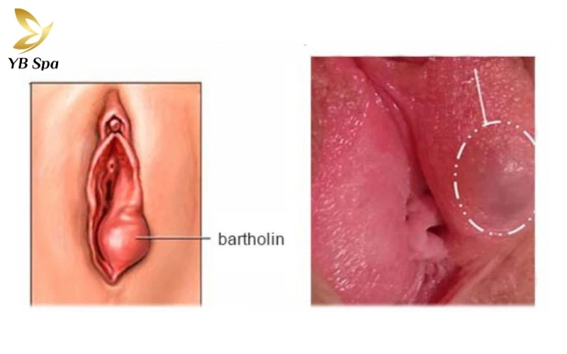 Hình ảnh nổi mụn ở vùng kín nữ - Khi nào cần đến gặp bác sĩ? 18 U tuyến Bartholin thường biểu hiện qua một khối sưng căng mọng, đỏ và nóng khu trú ở một bên mép cửa âm đạo
