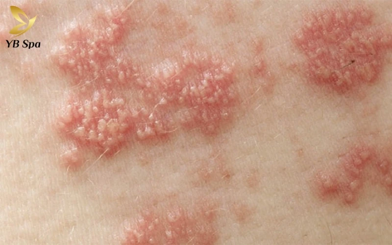 Hình ảnh nổi mụn ở vùng kín nữ - Khi nào cần đến gặp bác sĩ? 19 Herpes sinh dục thường biểu hiện qua các cụm mụn nước nhỏ li ti gây cảm giác châm chích và ngứa ngáy vùng kín