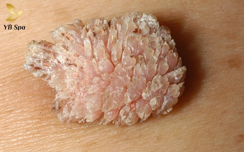 Hình ảnh nổi mụn ở vùng kín nữ - Khi nào cần đến gặp bác sĩ? 20 Các nhú gai khi liên kết lại sẽ tạo thành khối u sùi có bề mặt mấp mô đặc trưng giống như hình bông súp lơ