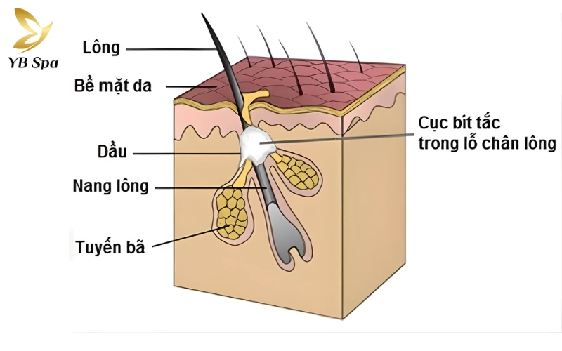Nổi Mụn Trắng Ở Bao Quy Đầu: Nguyên Nhân Và Cách Điều Trị 23 Tuyến bã nhờn hoặc nang lông tắc nghẽn