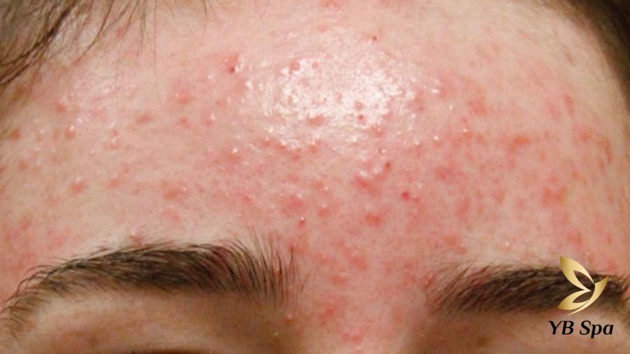 nổi mụn trên trán