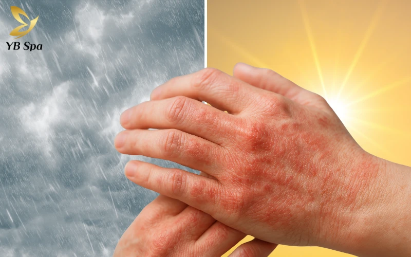 Nổi đốm đỏ trên da không ngứa có nguy hiểm không? 24 Dị ứng thời tiết hoặc thay đổi nhiệt độ đột ngột