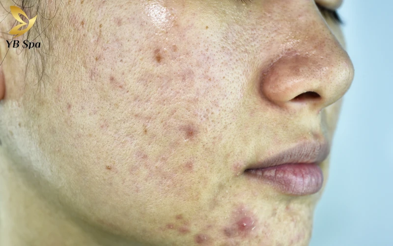 Nóng trong người nổi mụn nên uống gì để cải thiện làn da từ bên trong?