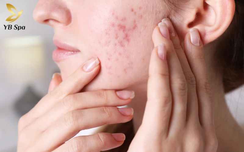 Nóng trong người ảnh hưởng đến làn da như thế nào?