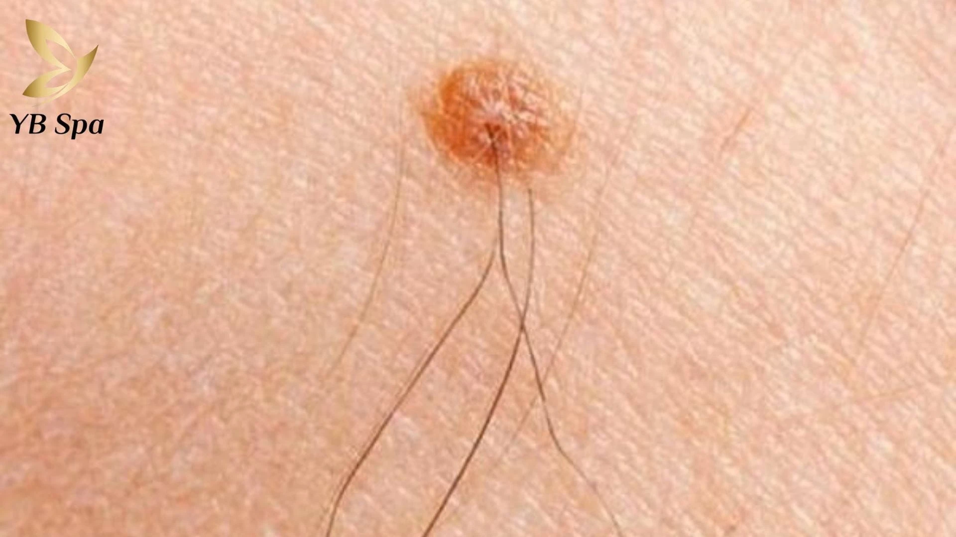 Quyết định giữ hay xóa nốt ruồi ở bụng phụ thuộc vào nhiều yếu tố quan trọng.