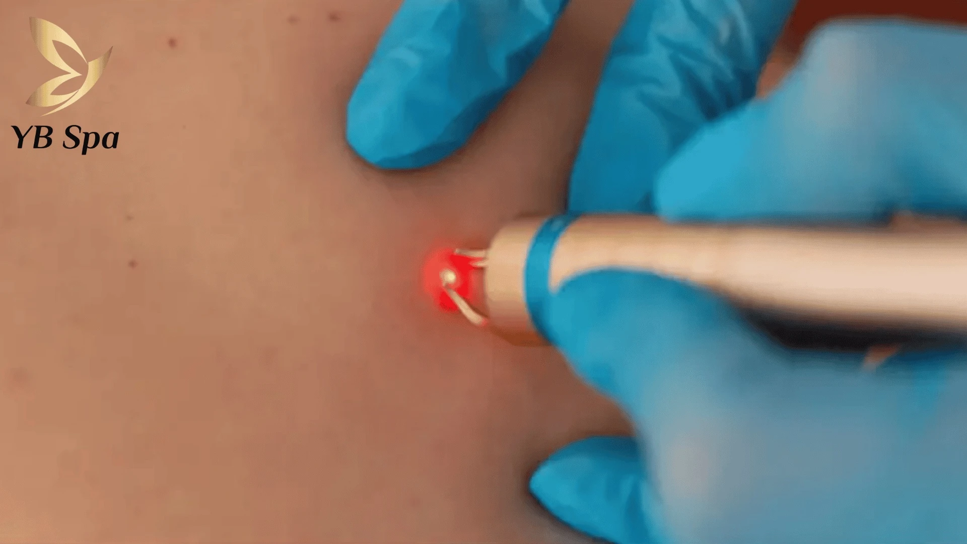 Ý nghĩa nốt ruồi ở ngón tay nam nữ và theo vị trí 24 Công nghệ Laser CO2 Fractional mang lại hiệu quả cao và an toàn trong việc loại bỏ nốt ruồi.