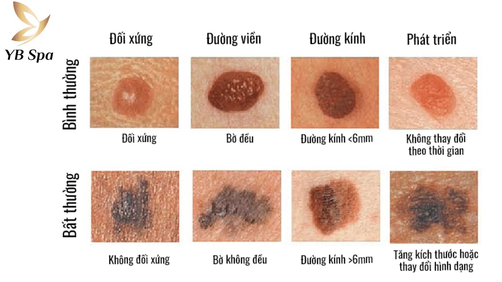 Cân nhắc xóa nốt ruồi vì lý do thẩm mỹ hoặc có dấu hiệu y tế bất thường.