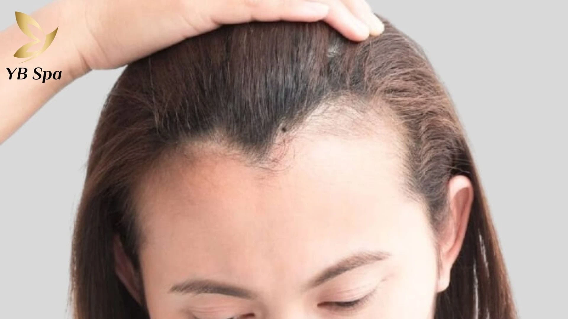 Ý Nghĩa Nốt Ruồi Ở Trán Theo Từng Vị Trí Và Lưu Ý Khi Tẩy 14 not ruoi o tran 4