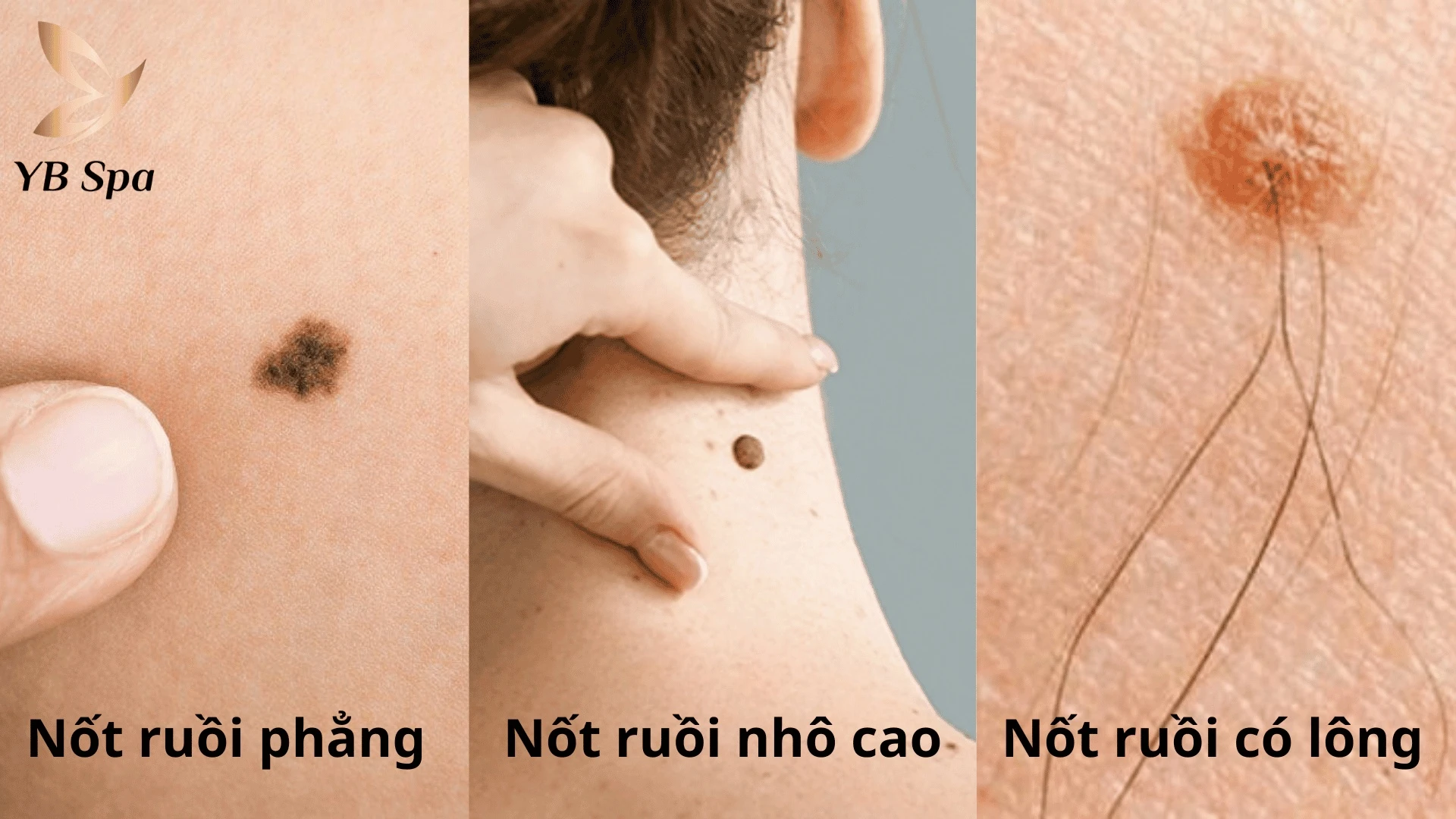 Hình minh họa các loại nốt ruồi thường gặp