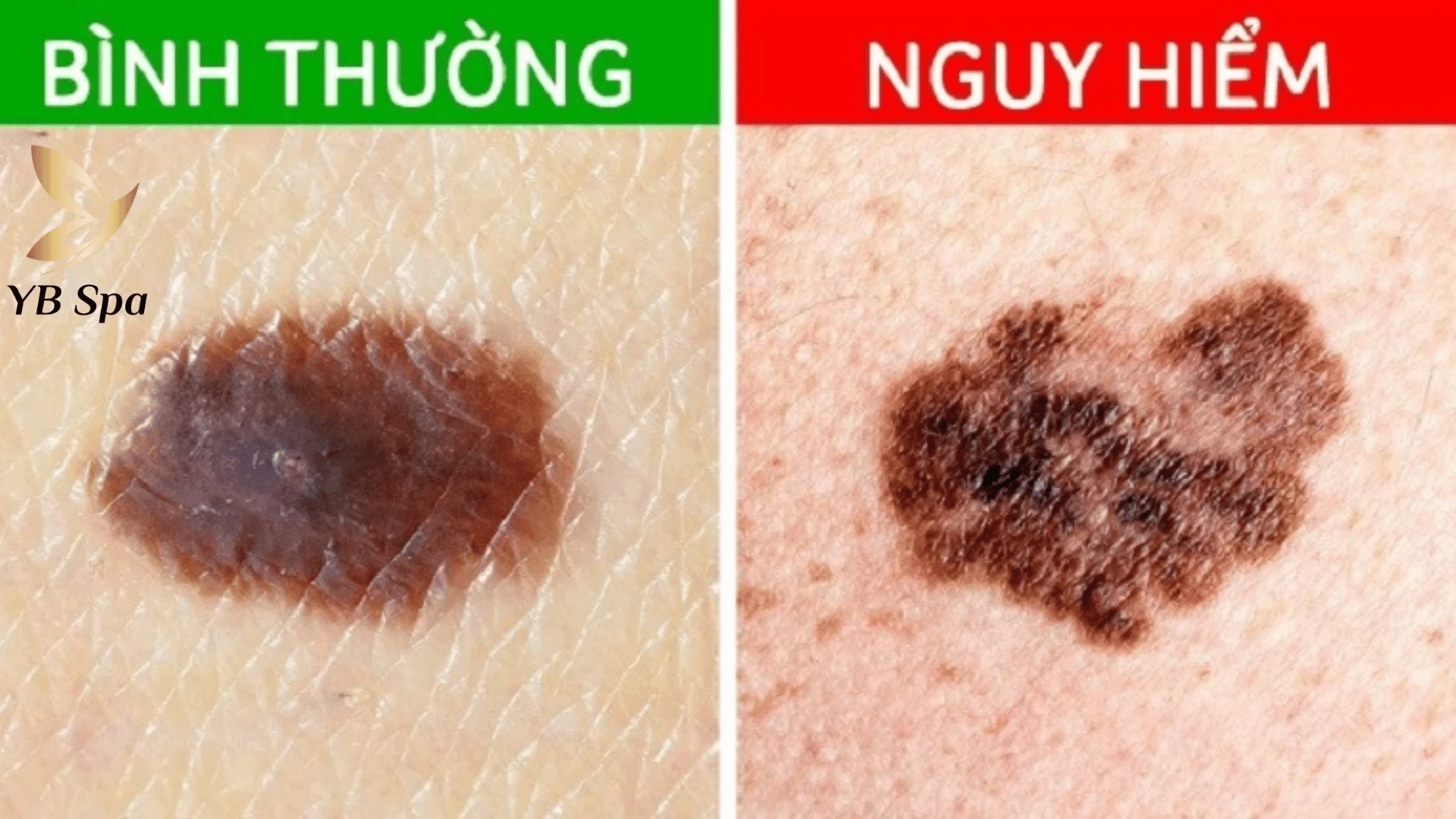Ý Nghĩa Nốt Ruồi Trên Vai Nam Và Nữ Theo Nhân Tướng Học 26 So sánh hình ảnh nốt ruồi bình thường và nốt ruồi cần sự can thiệp của bác sĩ da liễu.