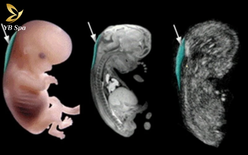 Độ Mờ Da Gáy Là Gì?