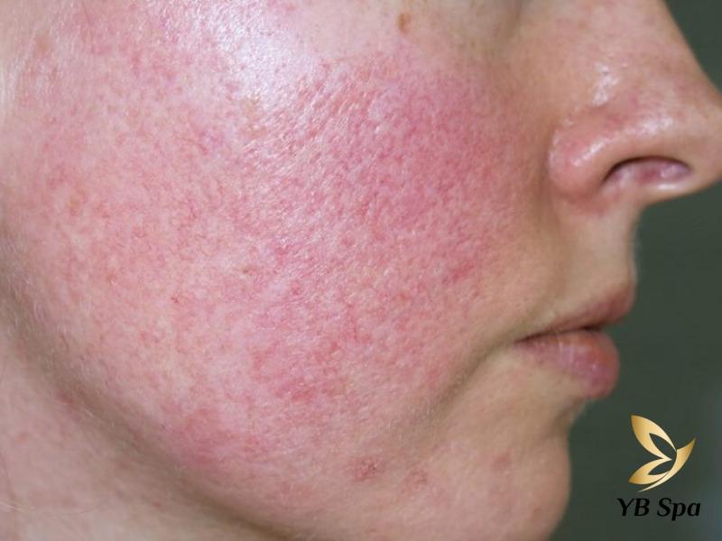 Peel da bị bỏng phải làm sao? Nguyên nhân và cách phục hồi 20 do đặc tính ăn mòn nên axit có thể gây bỏng da