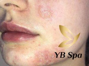 Peel da bị bỏng phải làm sao? Nguyên nhân và cách phục hồi