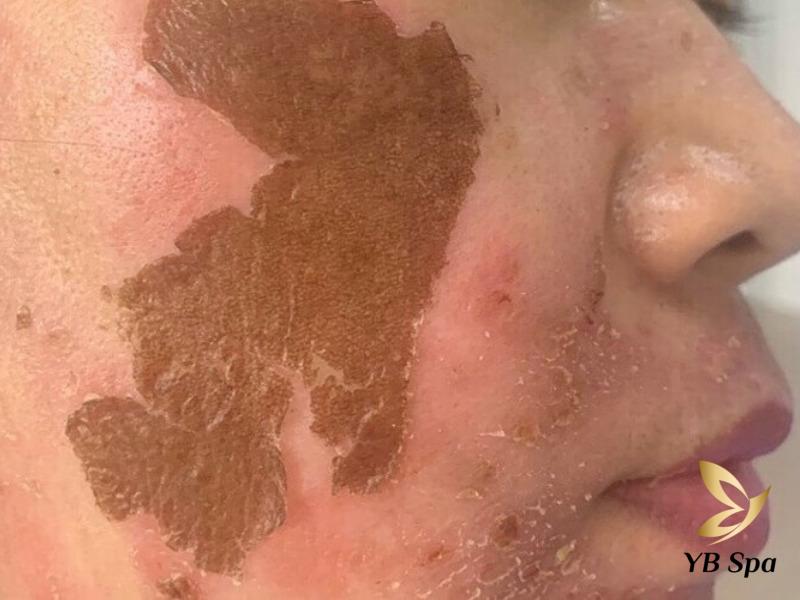 Peel da bị bỏng phải làm sao? Nguyên nhân và cách phục hồi 22 da bị bỏng nặng, hãy nghiêm chỉnh thực hiện theo hướng dẫn của bác sĩ