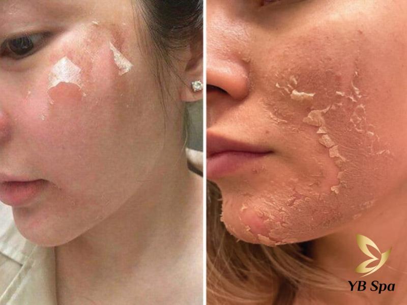 Peel da bị bỏng phải làm sao? Nguyên nhân và cách phục hồi 23 áp dụng đúng cách chăm sóc sau khi peel giúp da phục hồi nhanh chóng.