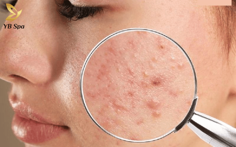 Peel da có đẩy mụn không? Cách phân biệt đẩy mụn và kích ứng 10 Peel da phá vỡ liên kết tế bào sừng già cỗi, tạo đường dẫn để mụn ẩn sâu dưới lỗ chân lông trồi lên bề mặt nhanh hơn