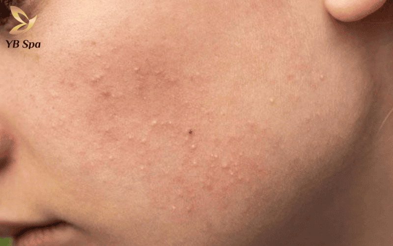 Peel da có đẩy mụn không? Cách phân biệt đẩy mụn và kích ứng 11 Tuần 1 và 2 là thời điểm "thanh lọc" khi các bít tắc sâu dưới lỗ chân lông dần lộ diện trên bề mặt da