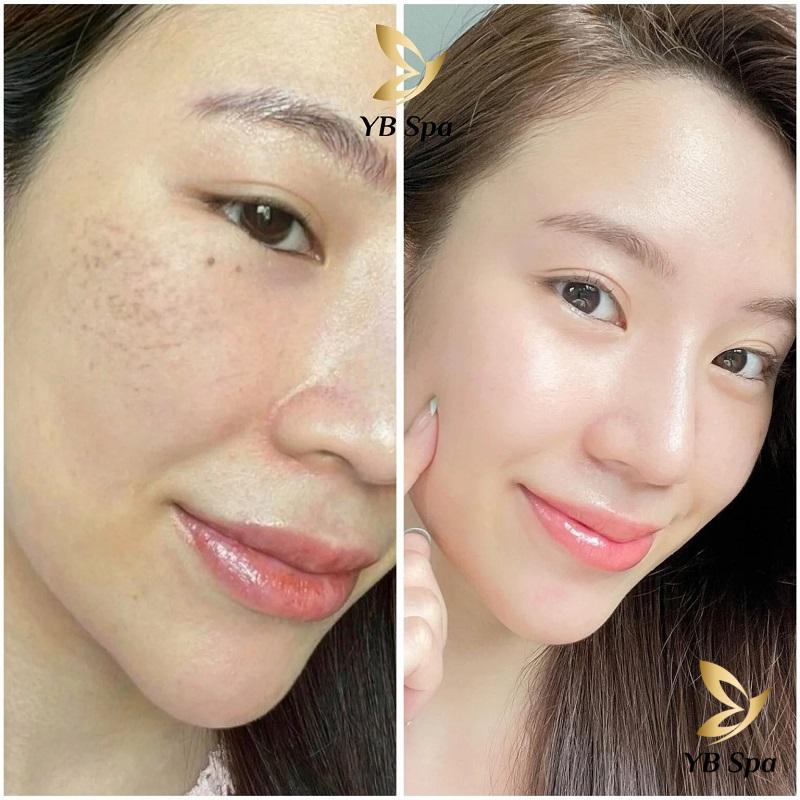 Peel da có đẩy mụn không? Nguyên nhân và cách xử lý 25 YB Spa là thương hiệu làm đẹp uy tín với hệ thống chi nhánh trải rộng khắp TP.Hồ Chí Minh