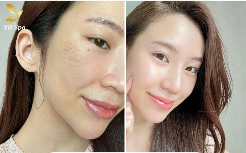 Peel Da Có Tác Dụng Gì? Các Loại Peel Da Phổ Biến Hiện Nay 19 Peel Da giúp Tối Ưu Hóa Khả Năng Tái Tạo Da