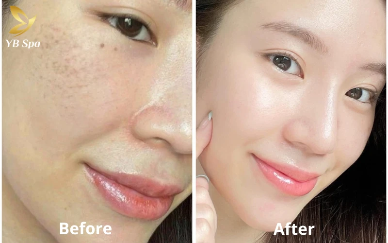 Peel da giá bao nhiêu? Bảng giá tham khảo mới nhất 2026 tại TP.HCM 13 Hình ảnh khách hàng Peel da trước sau