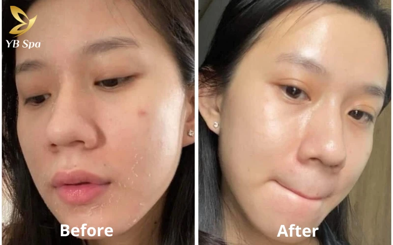 Peel da giá bao nhiêu? Bảng giá tham khảo mới nhất 2026 tại TP.HCM 14 Kết quả làn da mịn màng, sạch khuyết điểm của khách hàng chính là thước đo chính xác nhất cho uy tín của YB Spa trong năm 2026