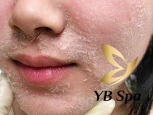 Có nên Peel da tại nhà không? Hướng dẫn Peel da tại nhà an toàn