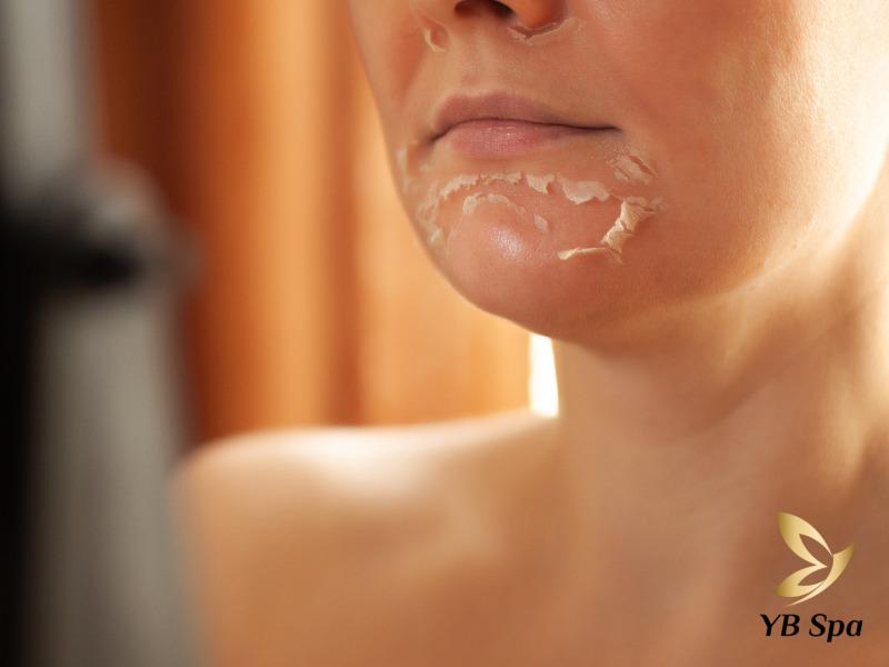 Peel da TCA là gì? Có nên Peel da TCA không? 19 Peel da TCA với Trichloroacetic Acid (TCA), là một lựa chọn phổ biến vì hiệu quả cao và an toàn.
