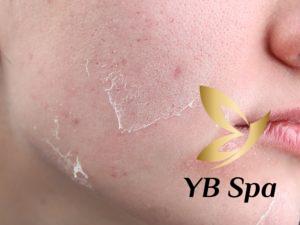 Peel da TCA là gì? Có nên Peel da TCA không?