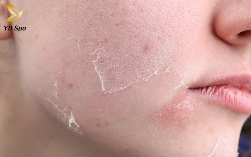 Peel da trị mụn là gì? Có an toàn và hiệu quả không? 33 Nhược điểm và phản ứng phụ thường gặp