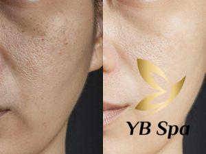 Peel da có trị nám được không? Có nên thực hiện hay không?