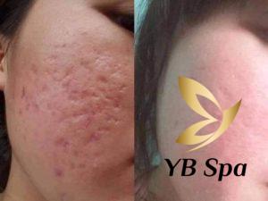 Peel da trị sẹo rỗ được không? Ưu và nhược điểm