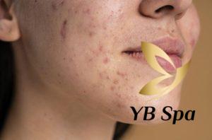 Peel da trị thâm là gì? Công dụng, ưu và nhược điểm