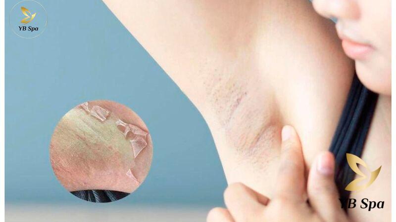 Peel nách là gì? Peel nách có trị thâm nách được không? 22 là kỹ thuật gây tổn thương lên bề mặt làn da, đưa các dưỡng chất thiết yếu vào trong lớp biểu bì