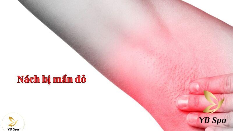 Peel nách là gì? Peel nách có trị thâm nách được không? 26 peel da vùng nách nếu không làm đúng cách sẽ có thể dẫn đến nhiều biến chứng nguy hiểm