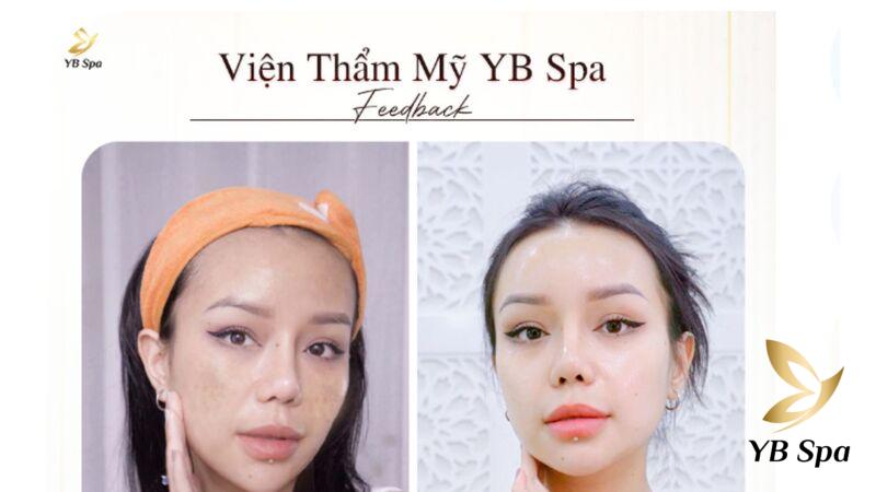 Peel nách là gì? Peel nách có trị thâm nách được không? 29 YB Spa với đội ngũ chuyên viên - kỹ thuật viên đảm bảo yếu tố chuyên môn cao, giàu kinh nghiệm