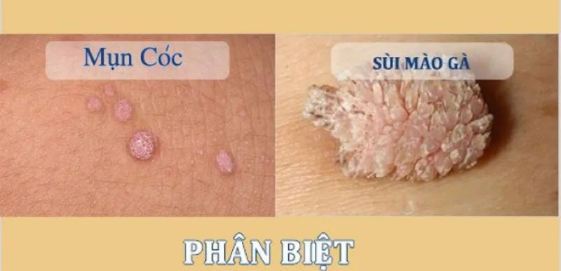 phân biệt mụn cóc và sùi mào gà