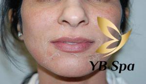 Phân biệt peel da và tẩy da chết? Điểm giống và khác biệt