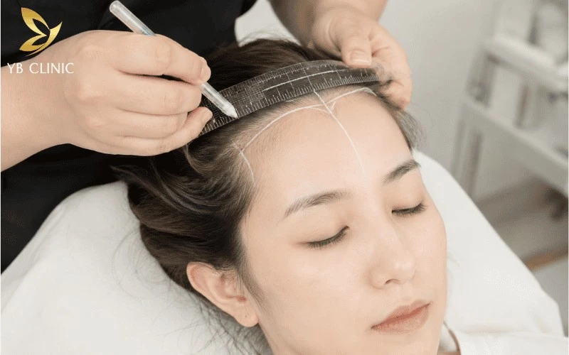 Quy Trình Triệt Tóc Trán Chuẩn Và Các Lưu Ý An Toàn 8 Thiết kế đường chân tóc chuẩn tỷ lệ giúp tạo viền tóc tự nhiên, hài hòa gương mặt và nâng cao hiệu quả triệt tóc trán.