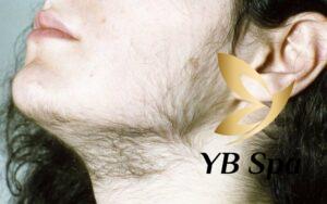 Rậm lông (Nguồn: Internet)