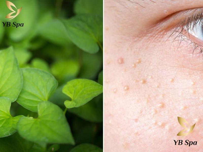 Rau diếp cá trị mụn có được không? Cần lưu ý gì? 23 rau diếp cá không phải là phương pháp điều trị mụn nhanh chóng