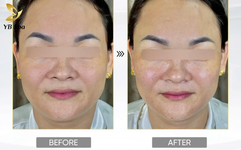 Review làm mặt thon gọn bằng LinearZ của khách hàng tại YB Spa