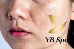 tiêm meso trị nám có tác dụng phụ không