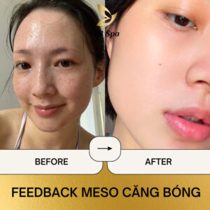 Feedback tiêm meso hiệu quả từ khách hàng (Nguồn: YB Spa)