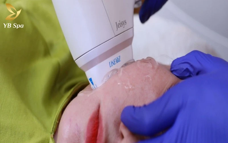 Review trải nghiệm LinearZ - Giải pháp trẻ hóa da không xâm lấn được tin chọn 22 Lịch sử phát triển của công nghệ HIFU LinearZ